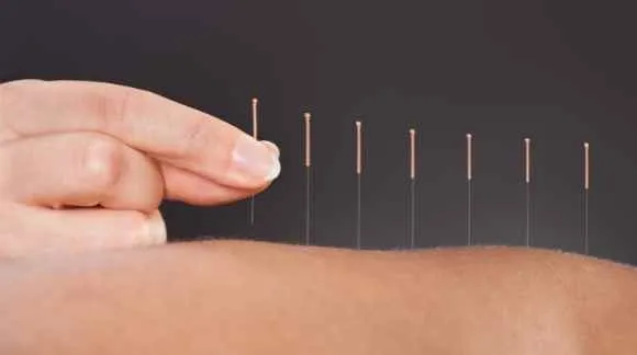 acupuntura em Taguatinga